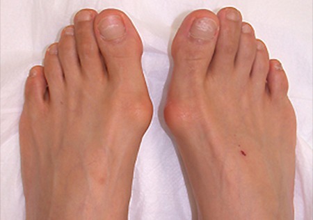 外反母趾ってどんな症状なの?