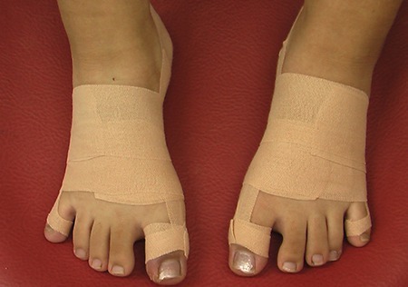 外反母趾の施術法