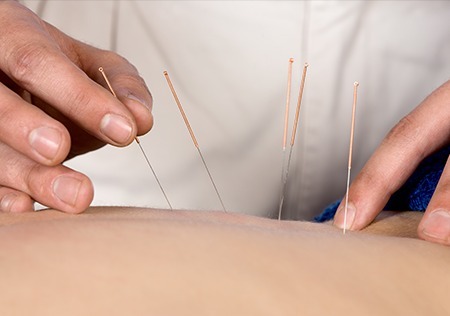 スポーツ鍼灸とは