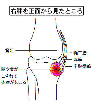 画像：鵞足炎の図解
