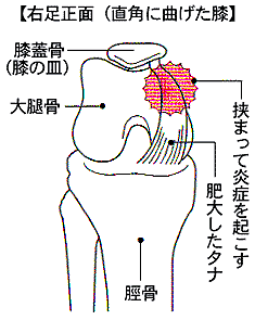 画像:棚障害の図解