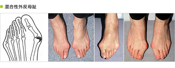 混合性外反母趾