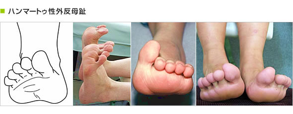 ハンマートゥ性外反母趾