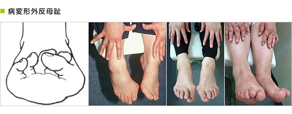 病変形外反母趾
