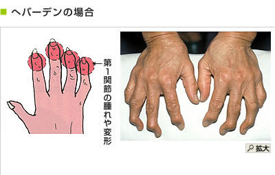 ヘバーデンによる外反母趾