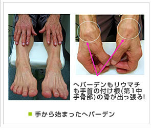 手から始まったへバーデン