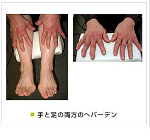 手と足の両方のへバーデン