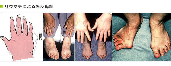 リウマチによる外反母趾