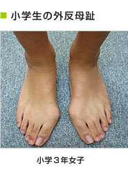 小学生の外反母趾　小学3年女子