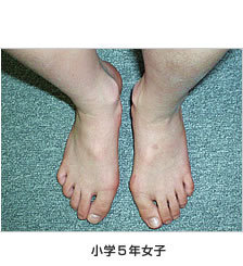 小学生の外反母趾　小学5年女子