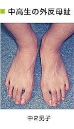 中高生の外反母趾　中2男子