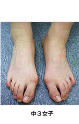 中高生の外反母趾　中3女子