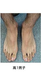 中高生の外反母趾　高1男子