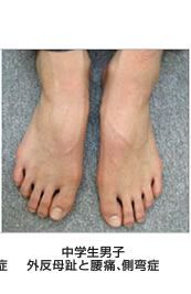 男性の外反母趾 中学生男子/外反母趾と腰痛、側弯症
