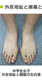 外反母趾と損傷との関係 中学生女子/外反母趾と顔面の左右差