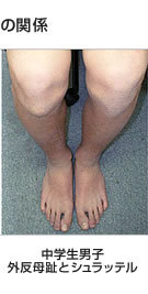 外反母趾と損傷との関係 中学生男子/外反母趾とシュラッテル