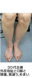 外反母趾と損傷との関係 30代主婦/外反母趾とO脚と頭痛、肩凝り、めまい