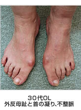 30代OL　外反母趾と首の凝り、不整脈