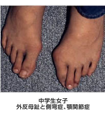 中学女子　外反母趾と側弯症、顎関節症
