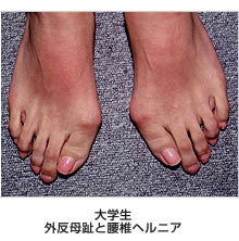 大学生　外反母趾と腰椎ヘルニア