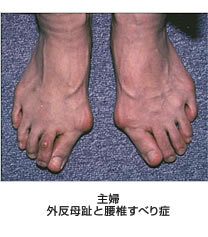 外反母趾と損傷との関係 主婦/外反母趾と腰椎すべり症