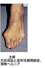 外反母趾と損傷との関係 主婦/外反母趾と変形性膝関節症、頚椎ヘルニア